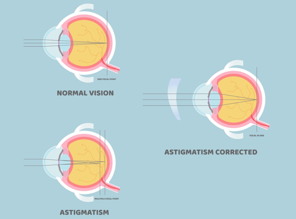 Qué es el astigmatismo? - Pérez No Es Ratón