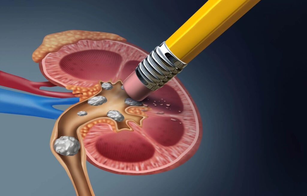 ¿Qué es la litiasis renal o piedras en el riñón?