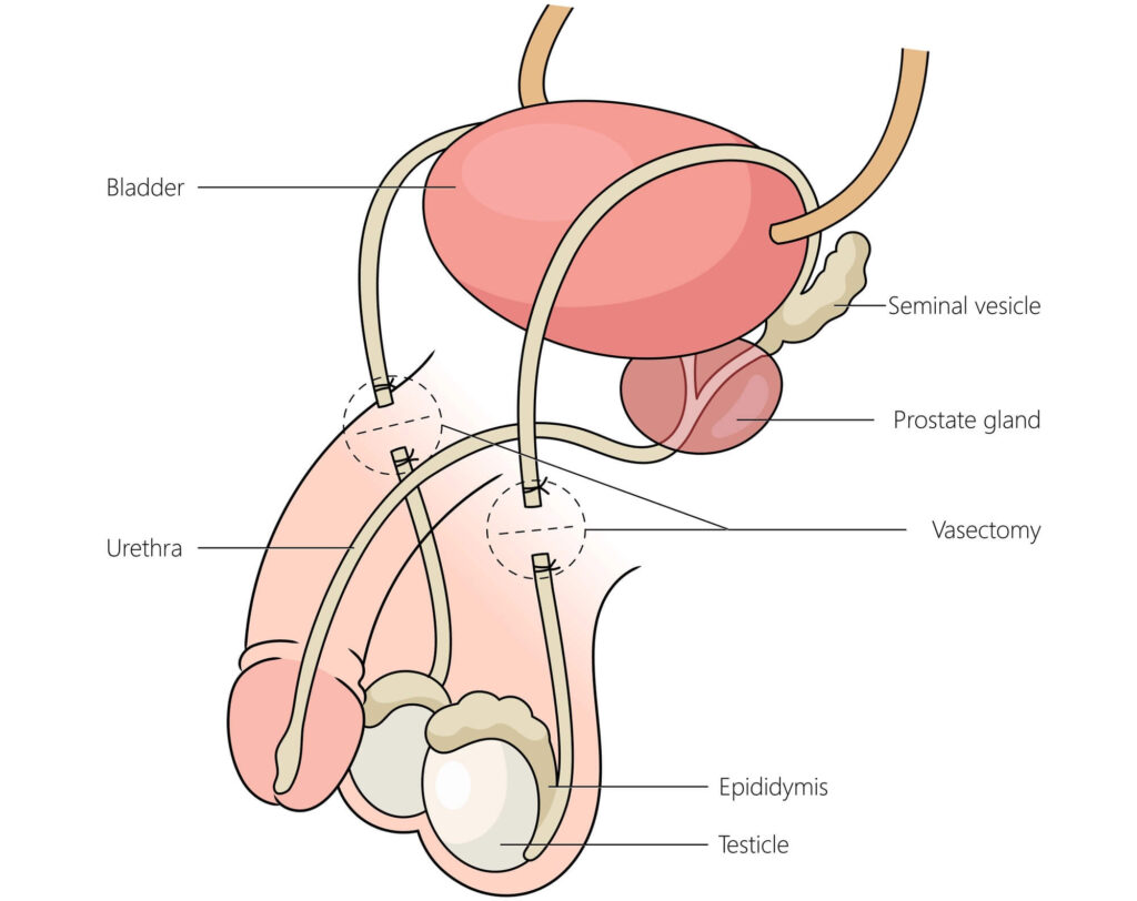 ¡Adiós a los mitos e inquietudes sobre la vasectomía!
